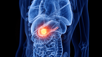 Complications of Diabetes