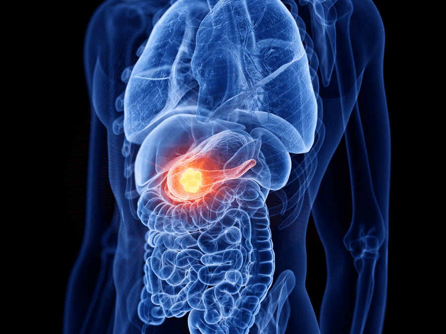 Complications of Diabetes