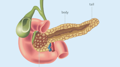 Diagnosing Diabetes Best Mineral for Pancreas Activation and Insulin resistance